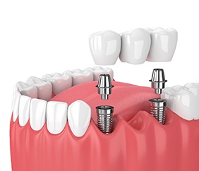 an illustration of an implant bridge in Mankato