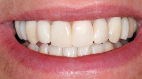 Bright healthy smile after cosmetic dentistry
