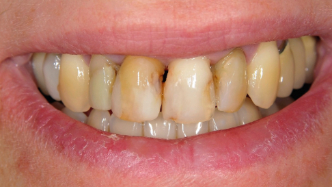 Yellow damaged smile before cosmetic dentistry