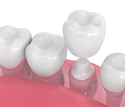 illustration of the process for dental crowns in Mankato