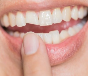 Patient pointing to smile with chipped front tooth