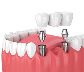implant bridge illustration for cost of dental implants in Mankato     