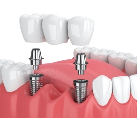 Animated smile during dental implant supported fixed bridge placement