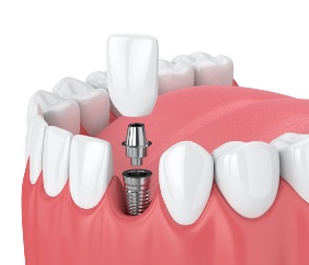 Animated smile during dental implant supported dental crown placement