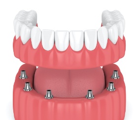 Animated smile during dental implant supported denture placement