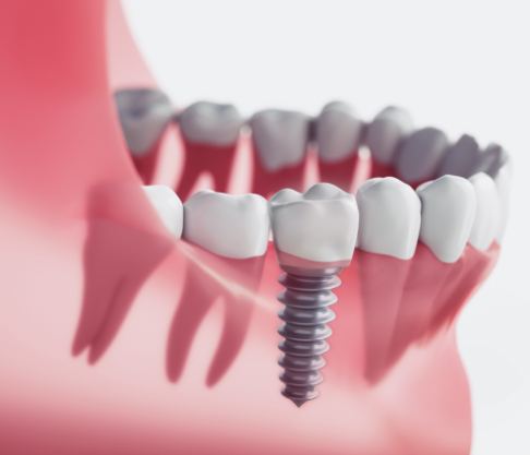 Animated smile with dental implant supported dental crown