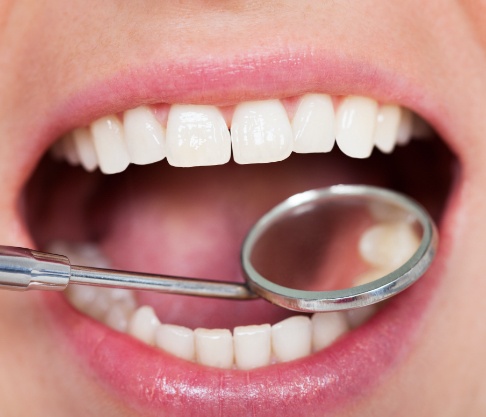 Dentist examining smile after dental sealant placement