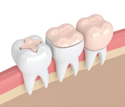 Animated teeth with dental crown compared to other types of dental restorations