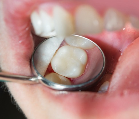 Dentist examining patient's smile after tooth colored filling treatment