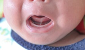 Baby with tongue-tie.